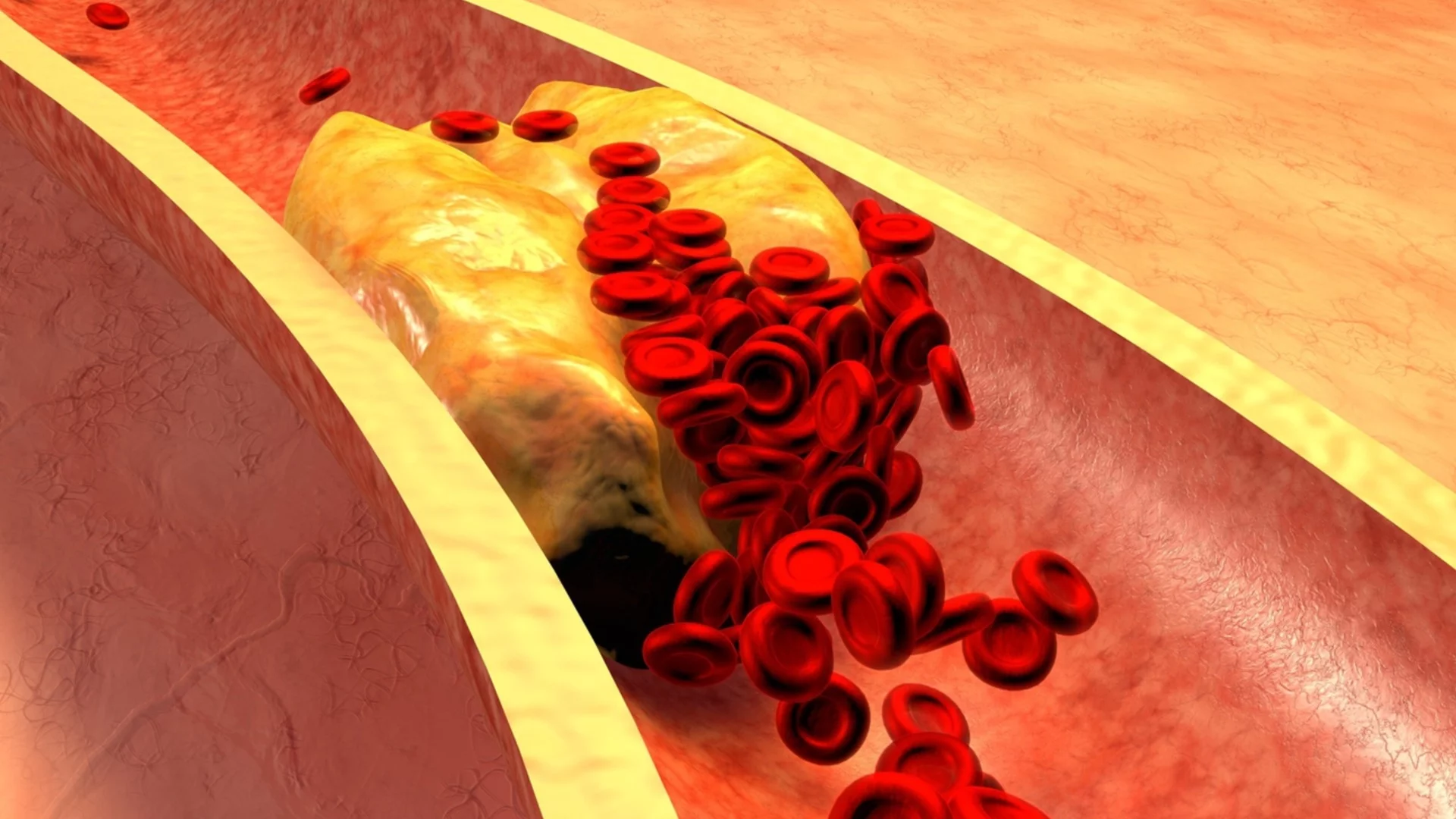  5 тихи признака на висок холестерол