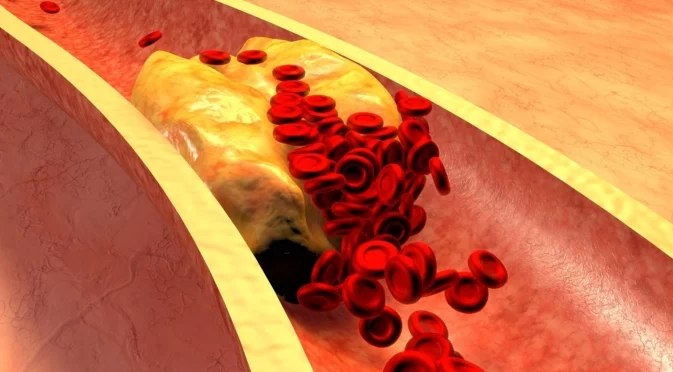  5 тихи признака на висок холестерол