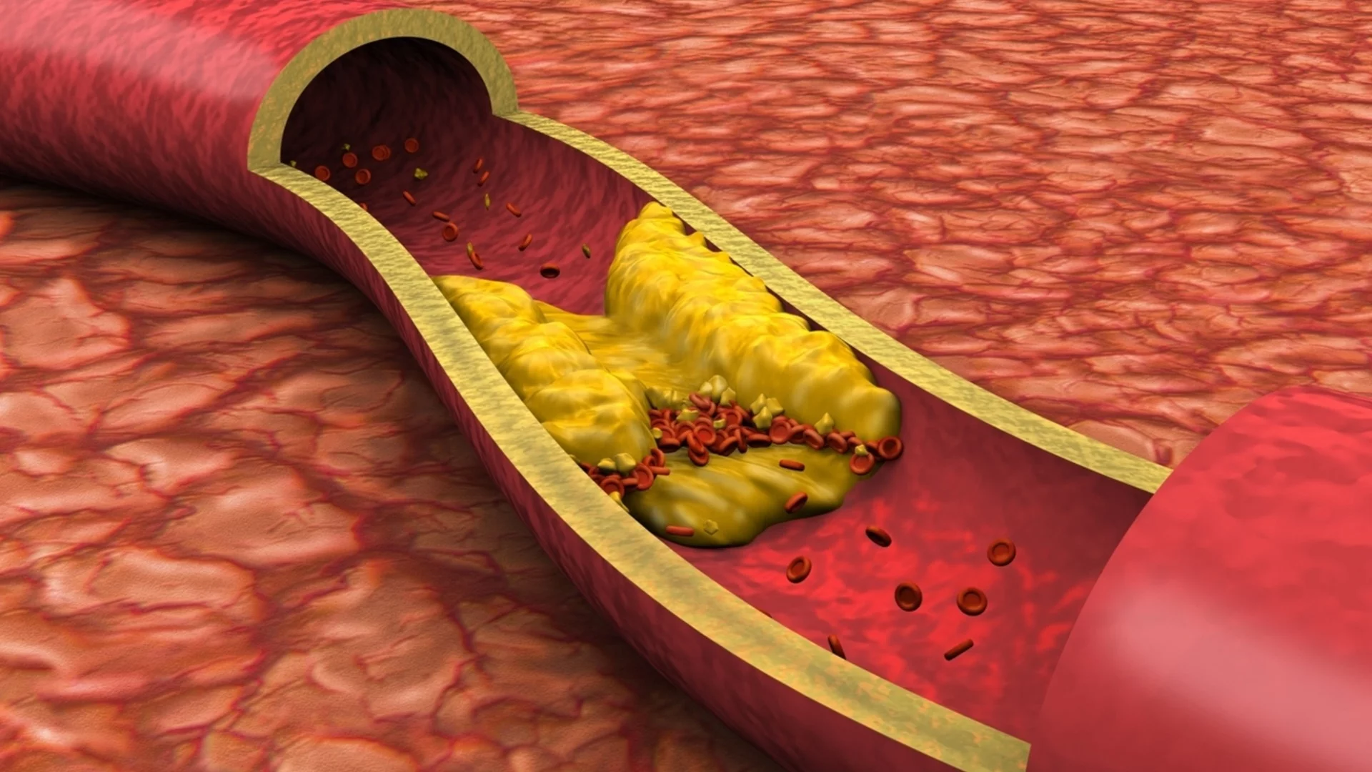 Зеленчук № 1 за предотвратяване на артериална плака 