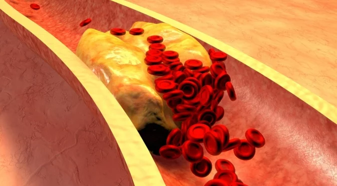 Може ли само диетата да помогне за подобряване на нивата на холестерола?