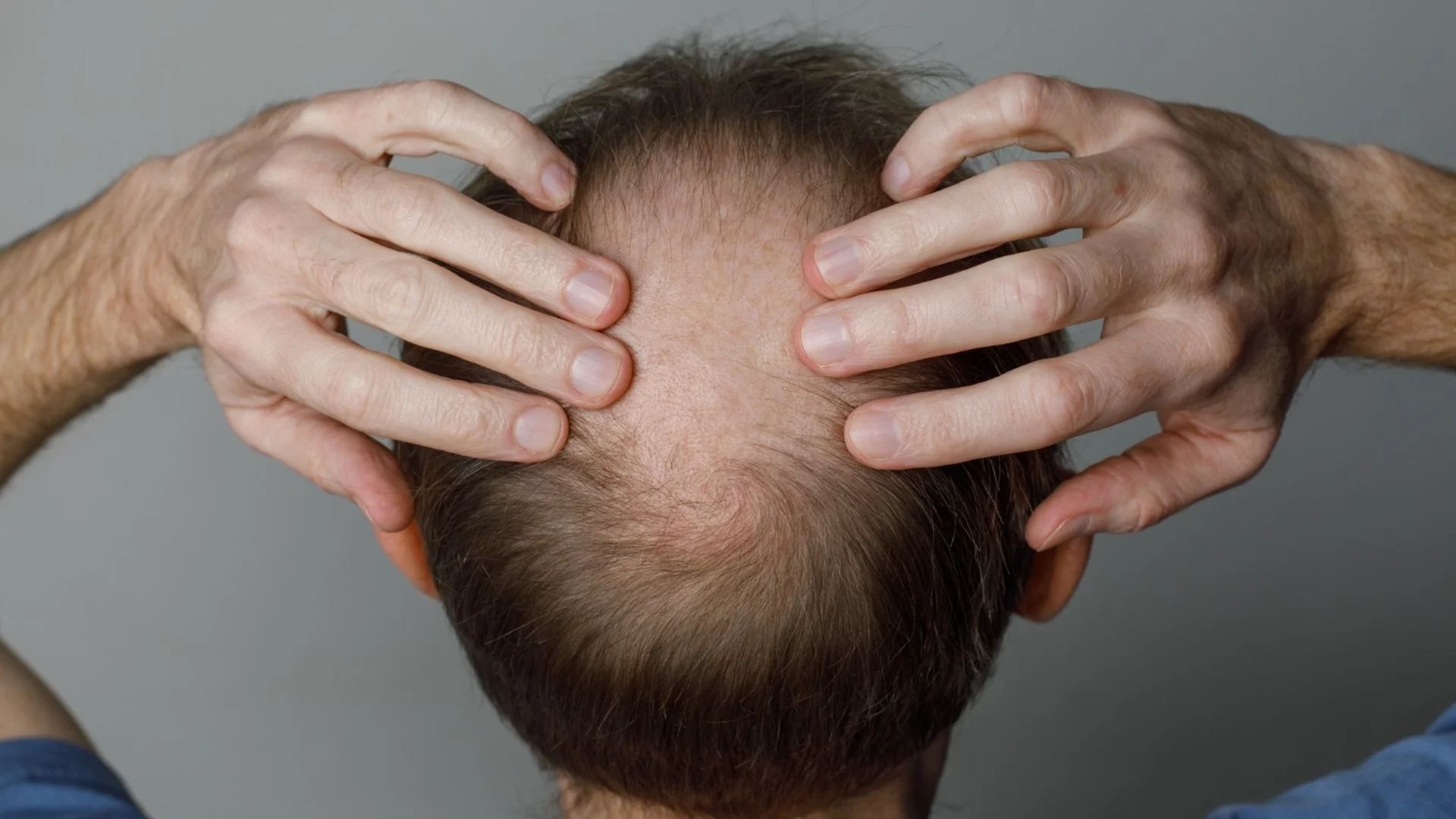 Пробив в лечението на косопад: Нов медикамент показва до 539% възстановяване