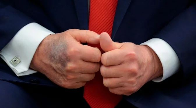 Тръмп прекалява с аспирина: Проговори и за синините по ръцете си