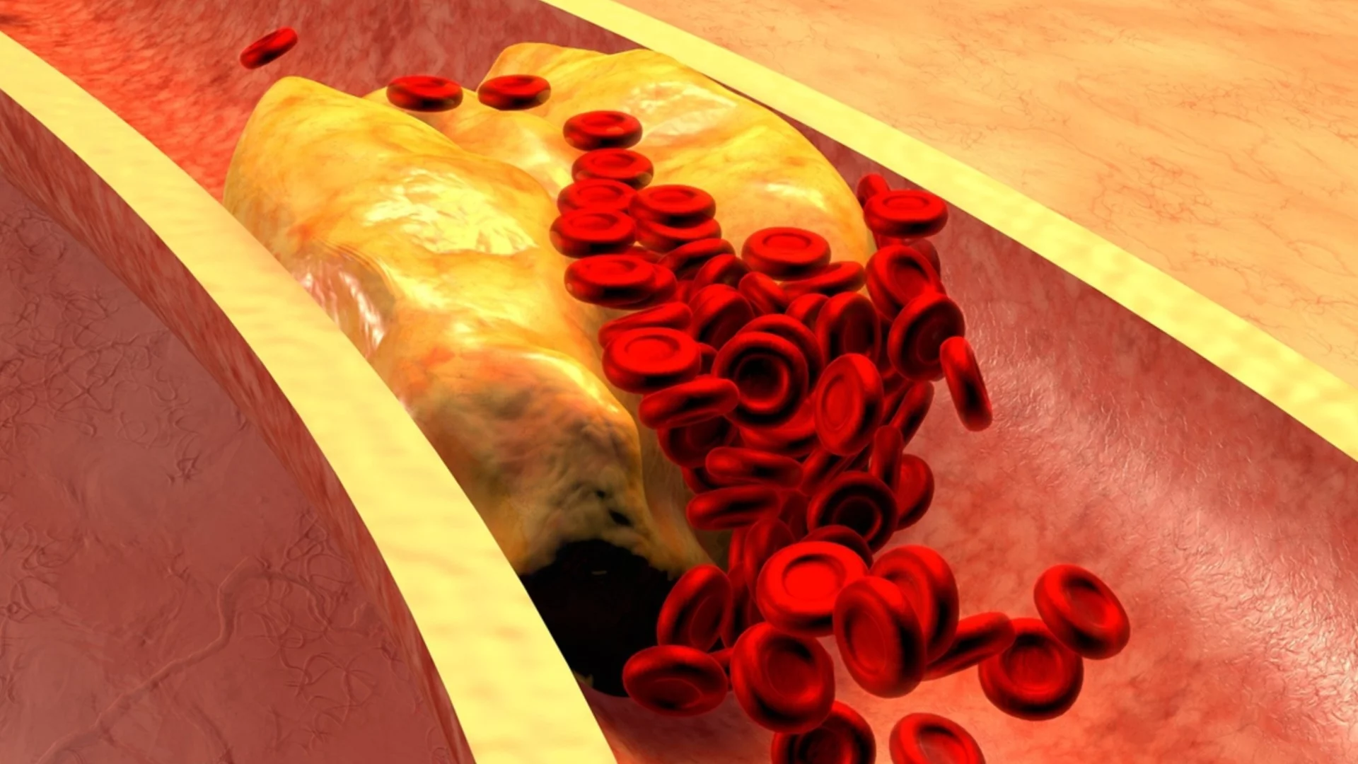 6 съвета за понижаване на холестерола, които действително работят