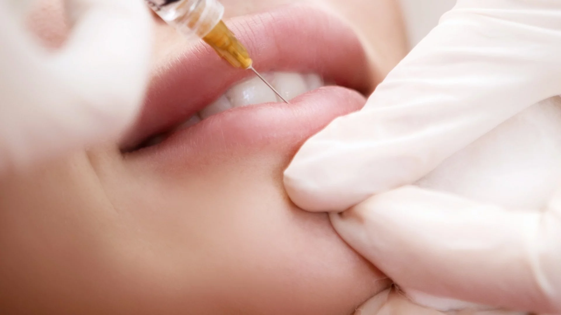 Усложненията след ботокс, хелаурон: Експерт предупреди кое е в основата на проблема