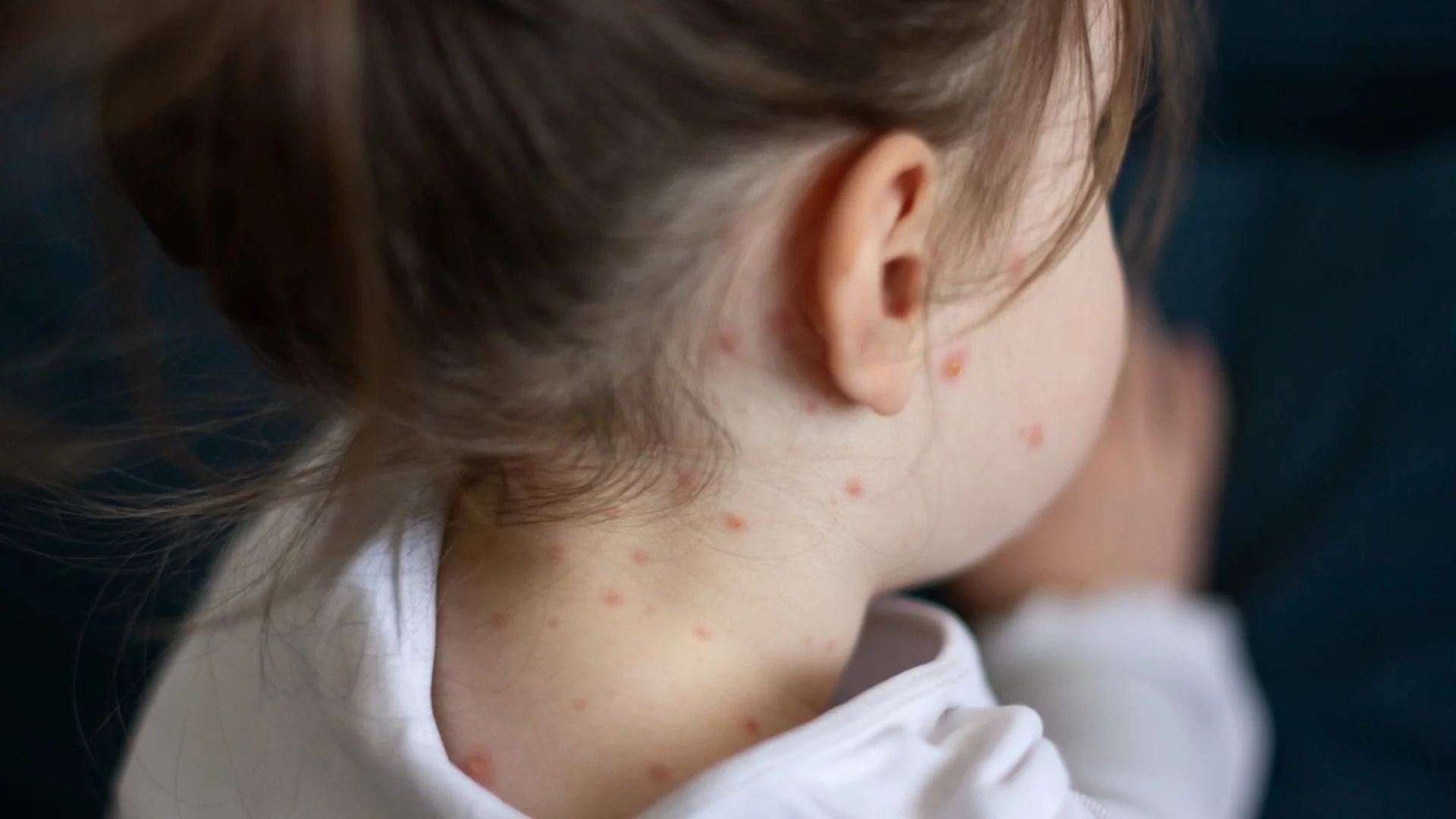 След драматичен спад във ваксинацията и огнище на морбили във Врачанско: МЗ разпореди извънредна имунизация на всички деца