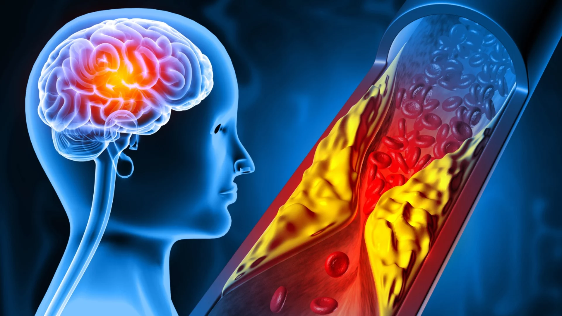 Магнитна течност, инжектирана директно в сърцето, може да ни спаси от инсулт