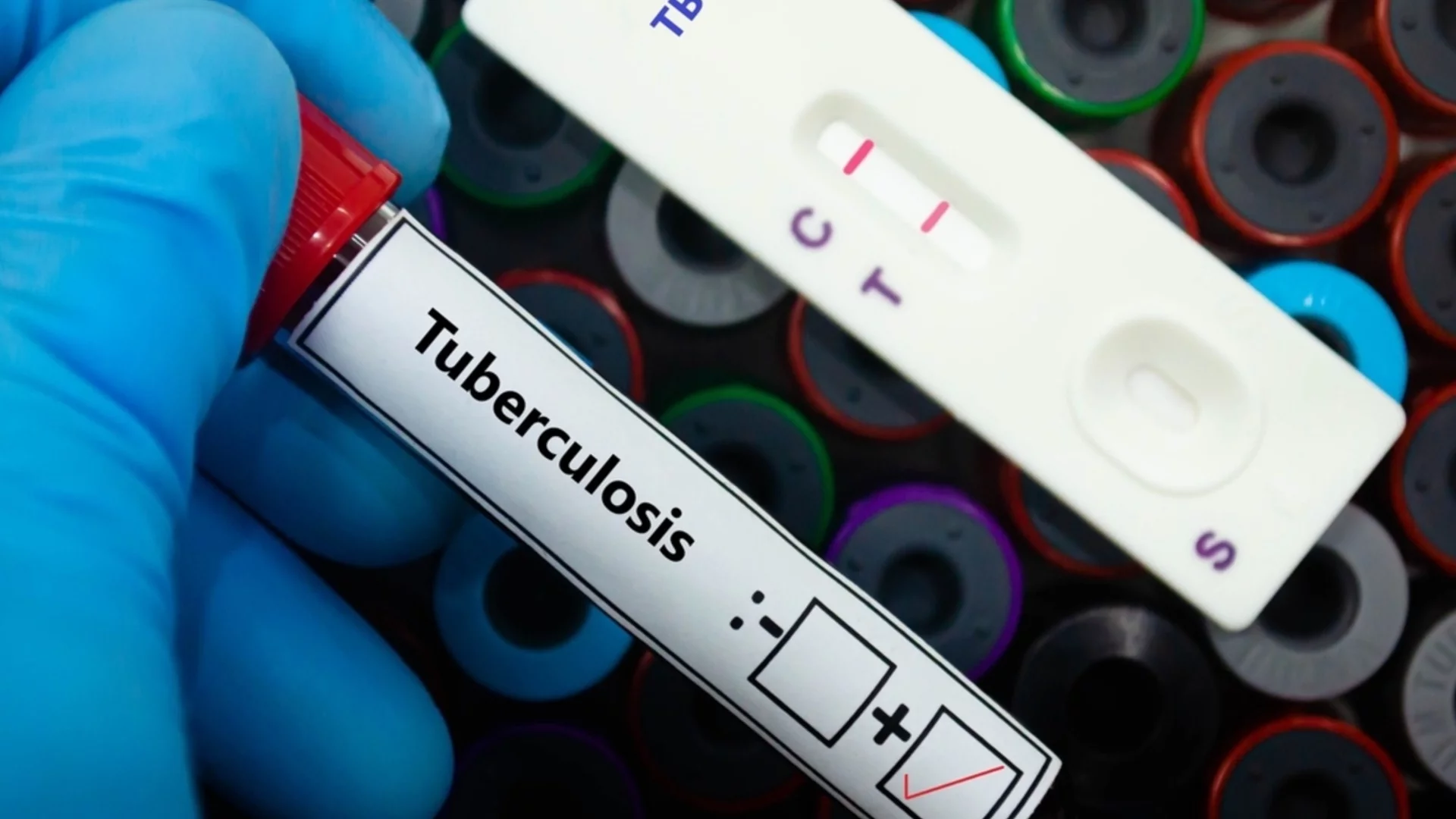 Един на всеки пет случая на туберкулоза остава незасечен