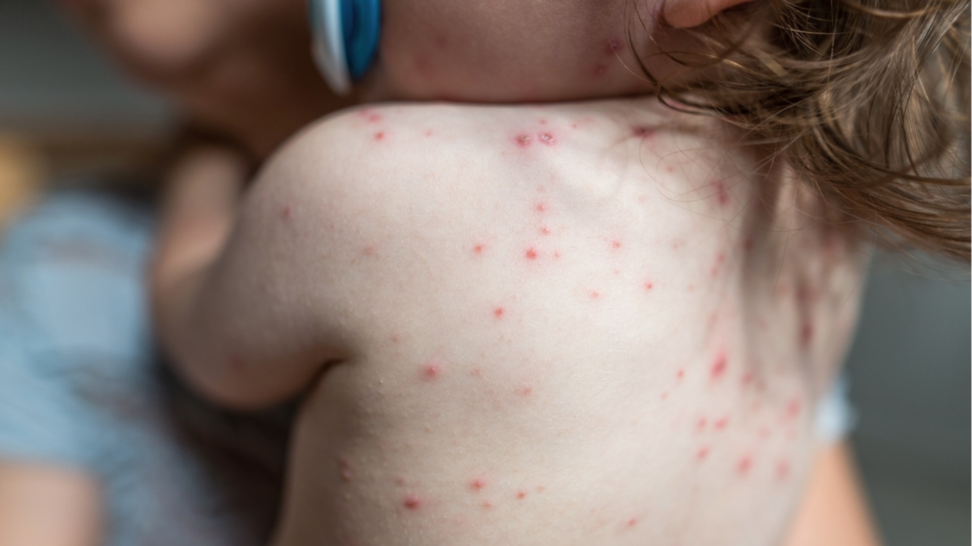 Морбилите са агресивно заболяване: Епидемиолог каза, че има лекари, които не искат да поставят ваксини