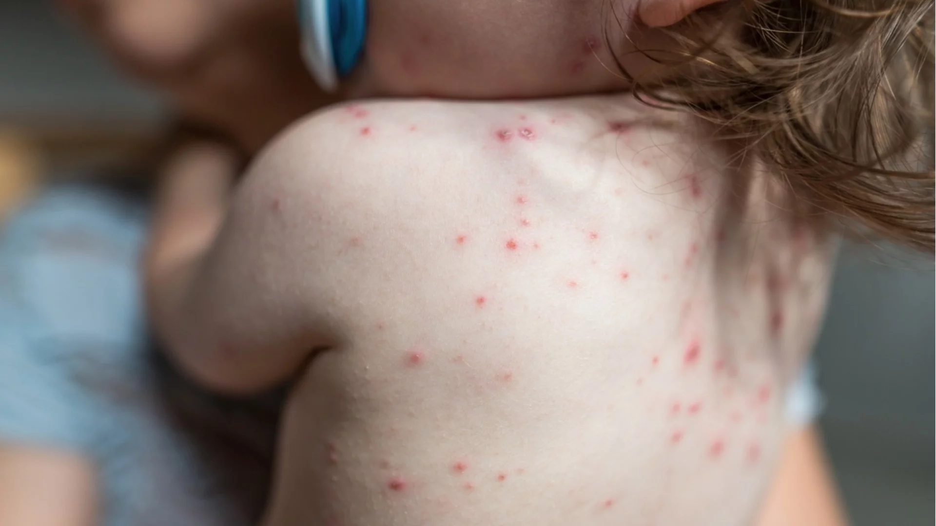 Морбилите са агресивно заболяване: Епидемиолог каза, че има лекари, които не искат да поставят ваксини