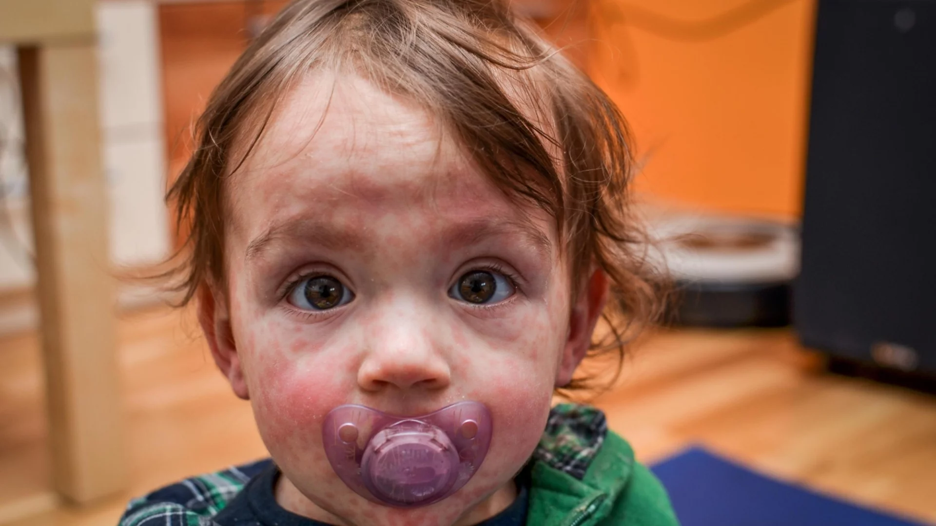 18 са вече заболелите: 6 паралелки в Бяла Слатина под карантина заради морбили