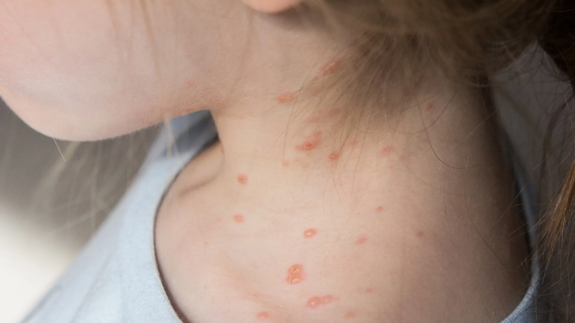 Увеличават се случаите на морбили у нас