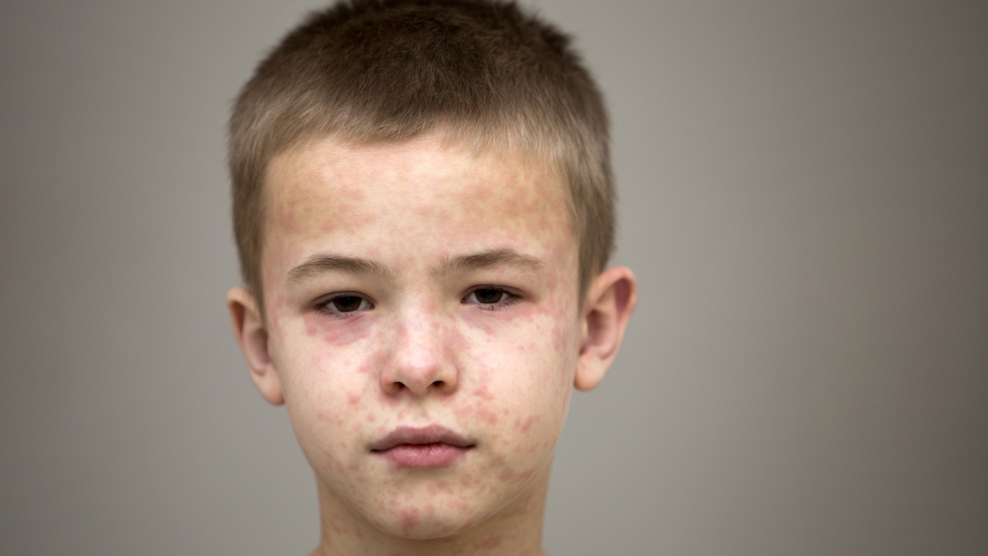 На фона на пълни болници и бум на заразата: Антиваксъри са се мобилизирали срещу ваксинацията за морбили