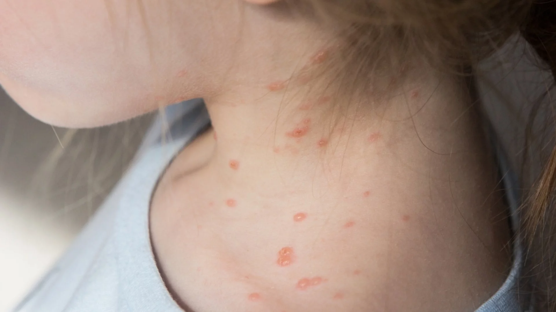 Заразата от морбили продължава да настъпва у нас