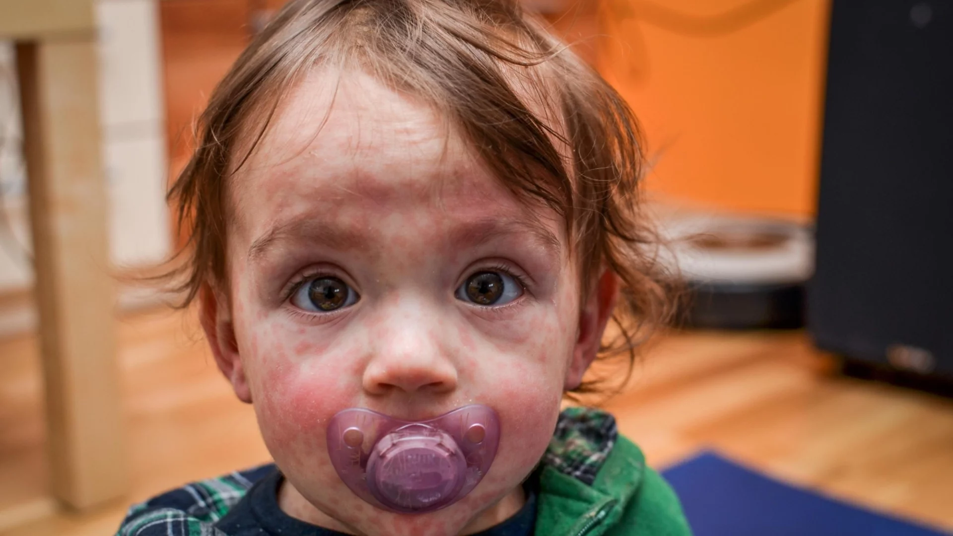 "Морбили ще гори, докато има горивен материал": Болните у нас вече са 80