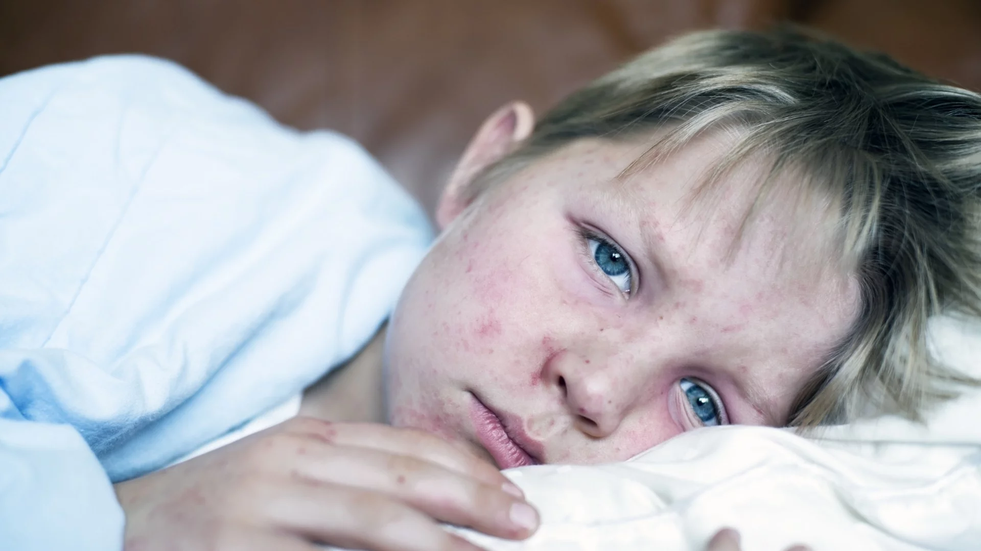 Морбилите настъпват: Случаите в София се увеличават