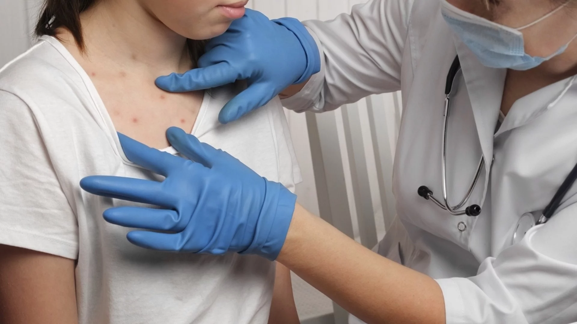 Над 100 са вече заболелите от морбили у нас