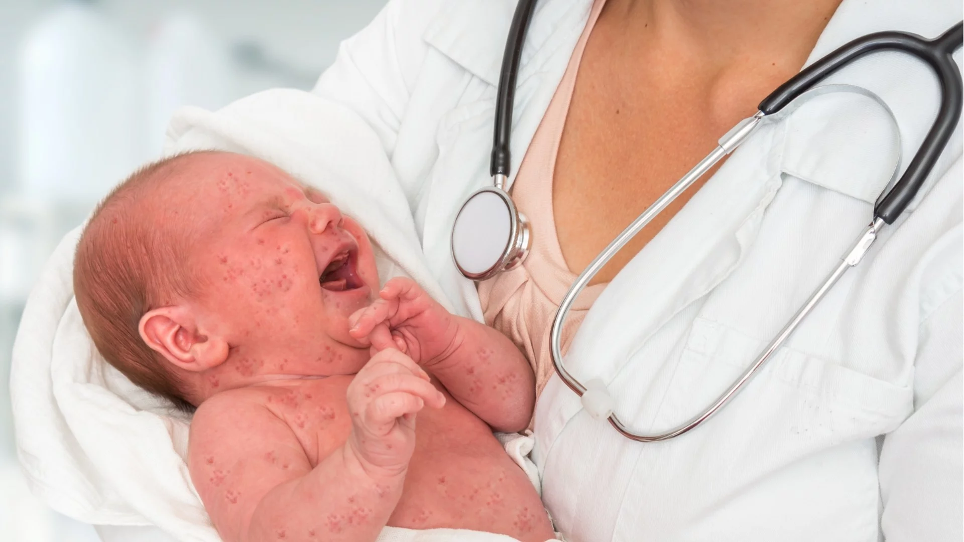 Няма епидемия, а епидемичен взрив от морбили: Проф. Ива Христова с последни данни за заразата