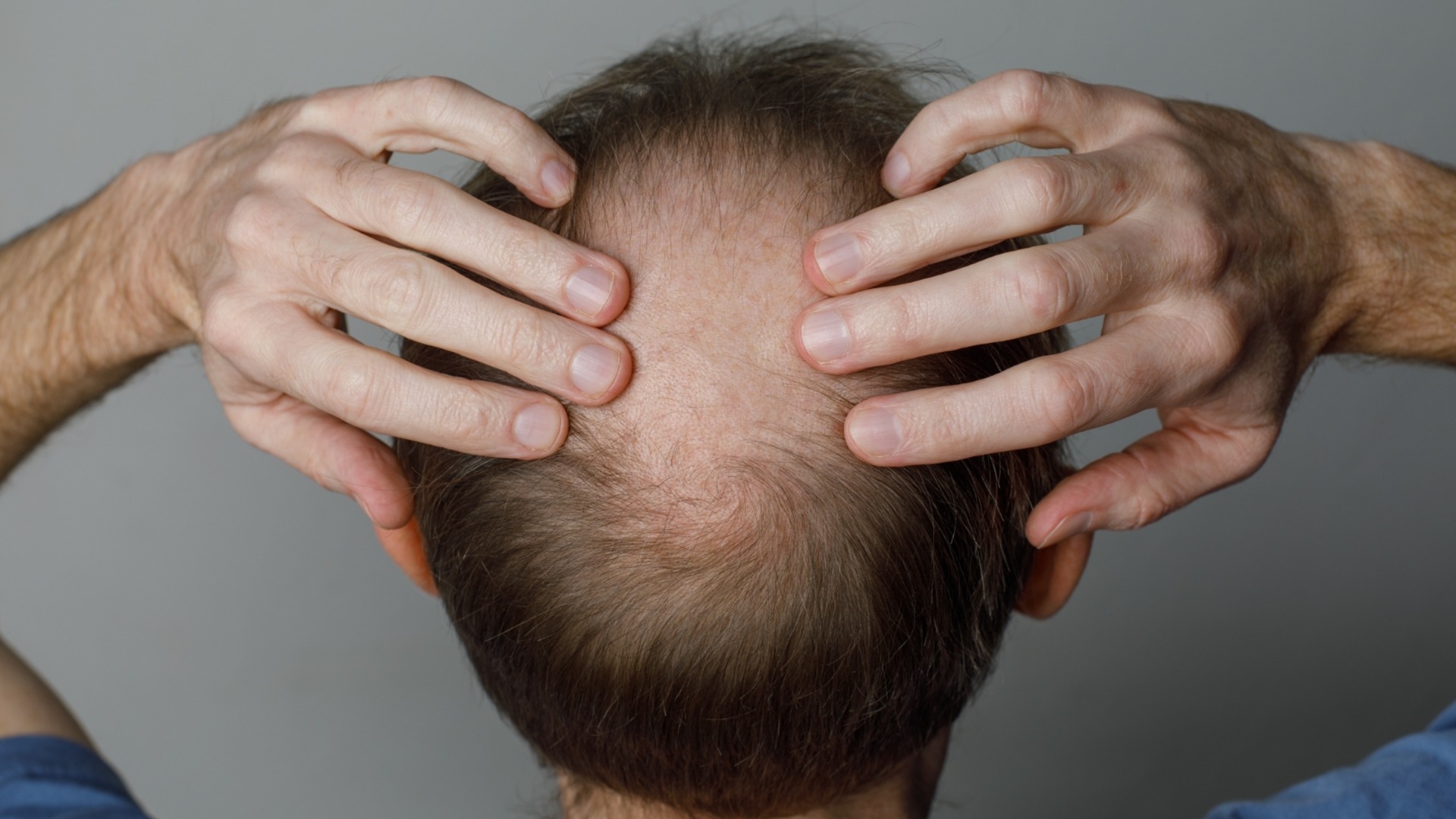 Доктори посочиха конкретното време за края на плешивостта при мъжете