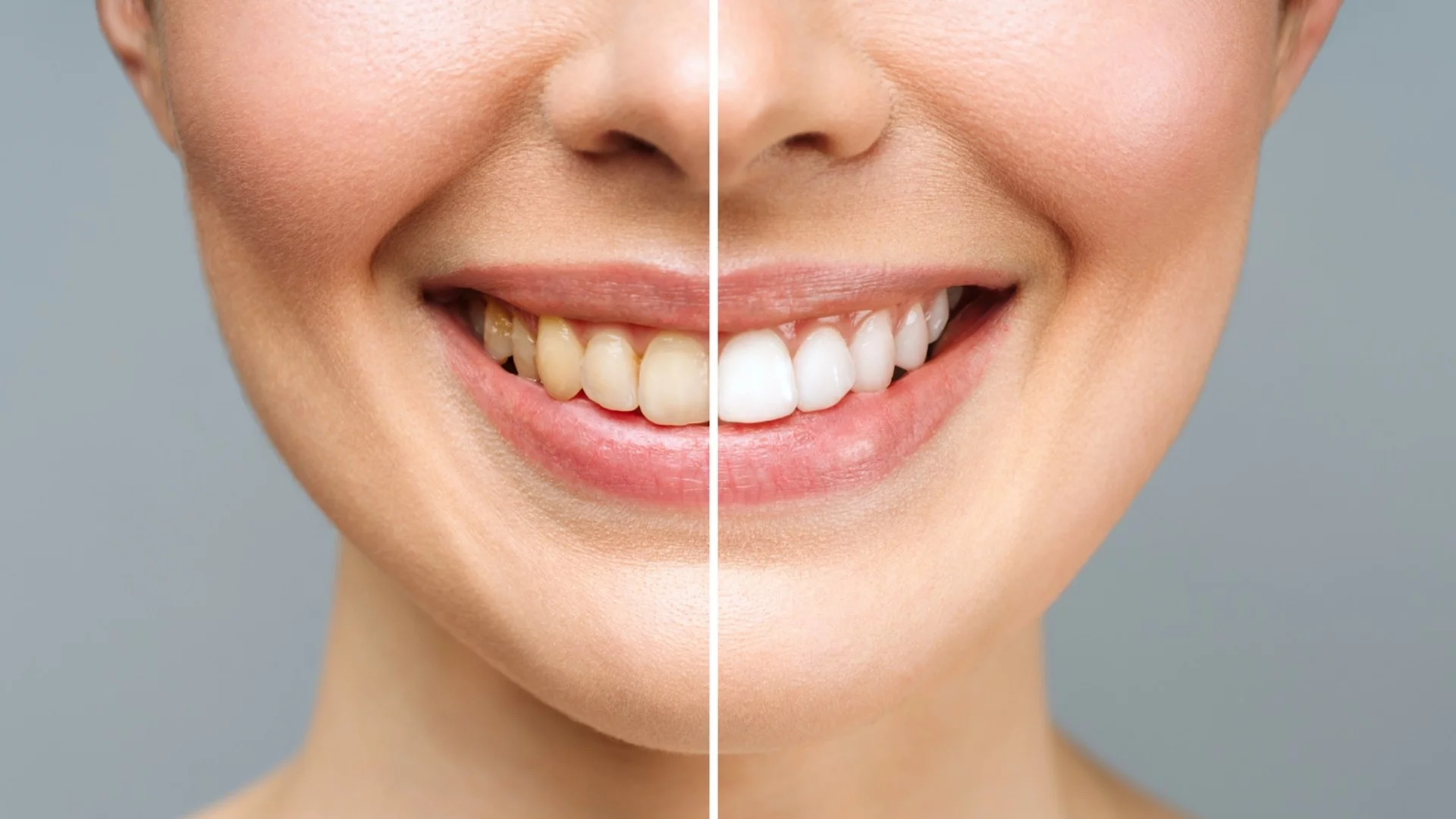 Жълтеникави или снежнобели? Истината за цвета на зъбите, която стоматолозите рядко споделят