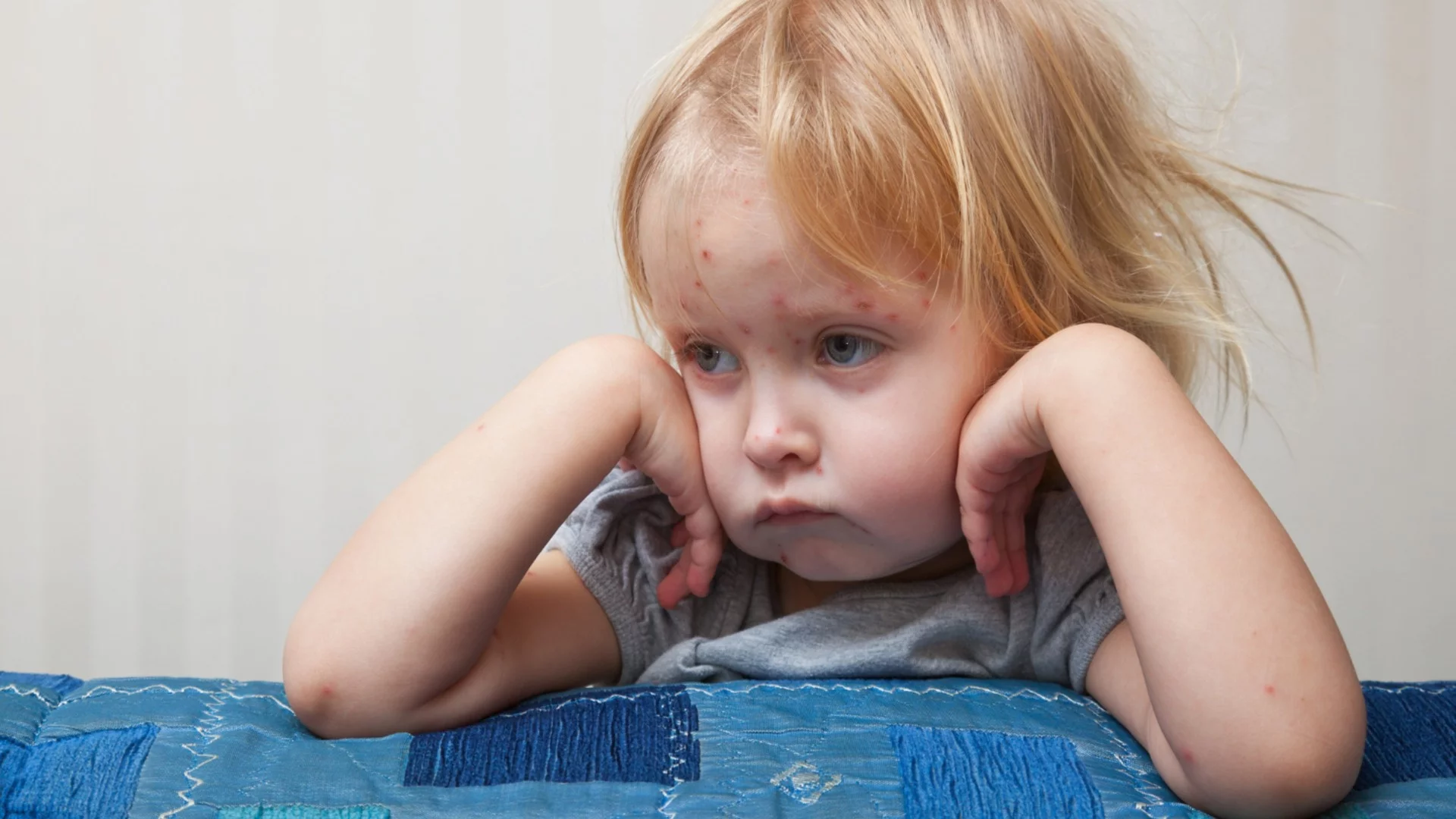 Все повече случаи на морбили в България: Какво да правим при контакт със заразен?